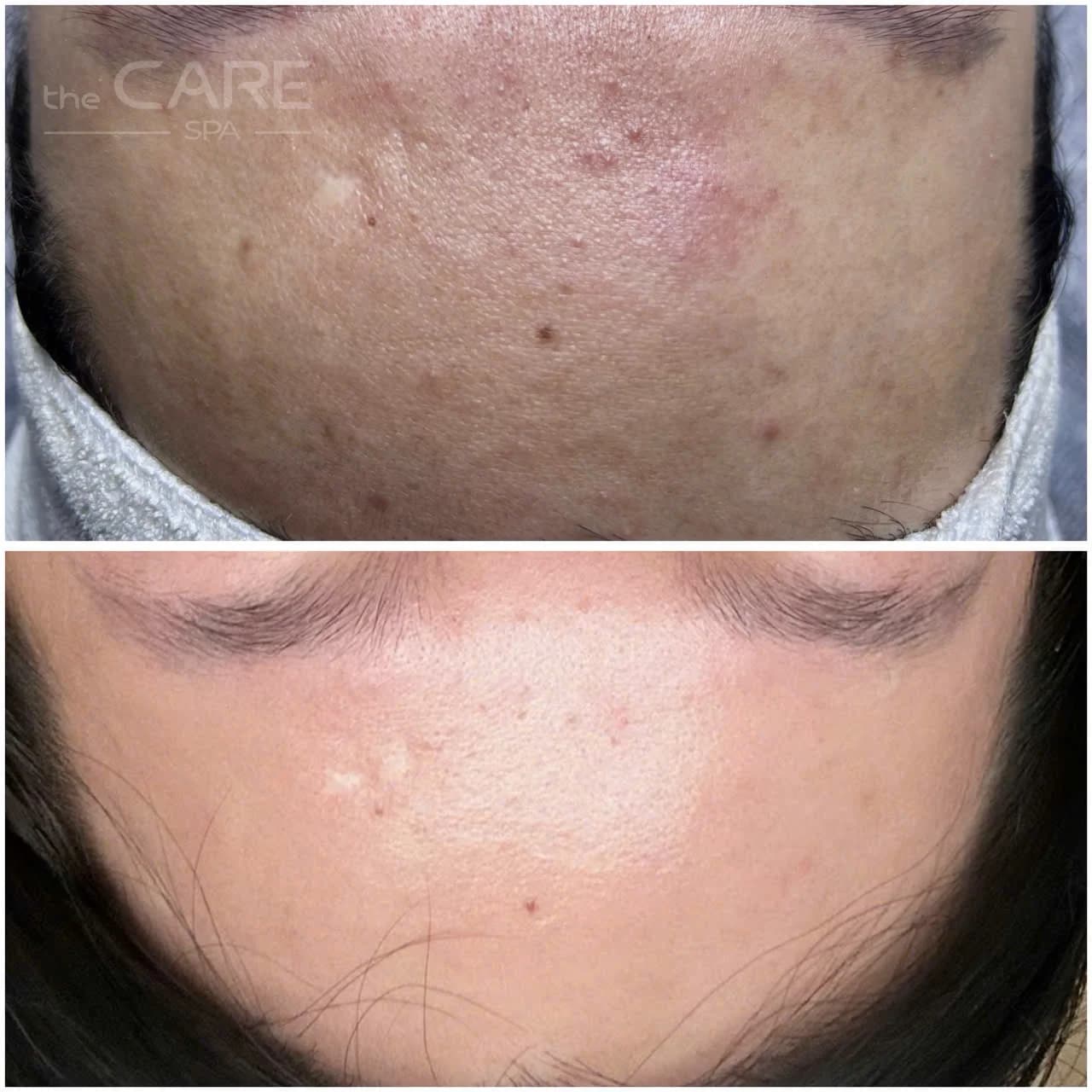 Kết quả trước và sau điều trị da tại The Care Spa