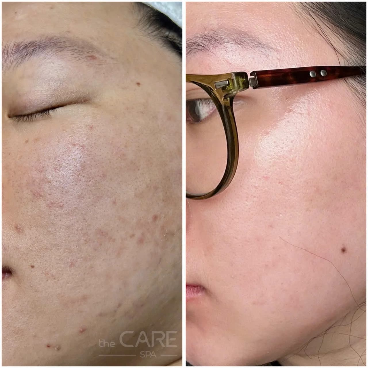 Kết quả trước và sau điều trị da tại The Care Spa