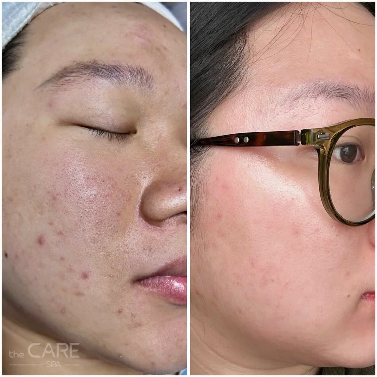 Kết quả trước và sau điều trị da tại The Care Spa
