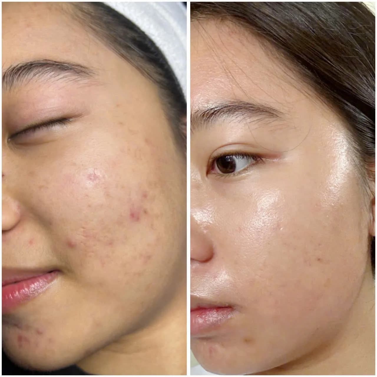 Kết quả trước và sau điều trị da tại The Care Spa