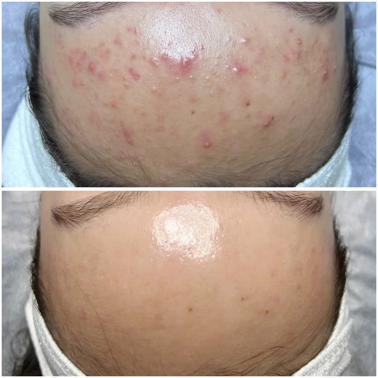 Kết quả trước và sau điều trị da tại The Care Spa