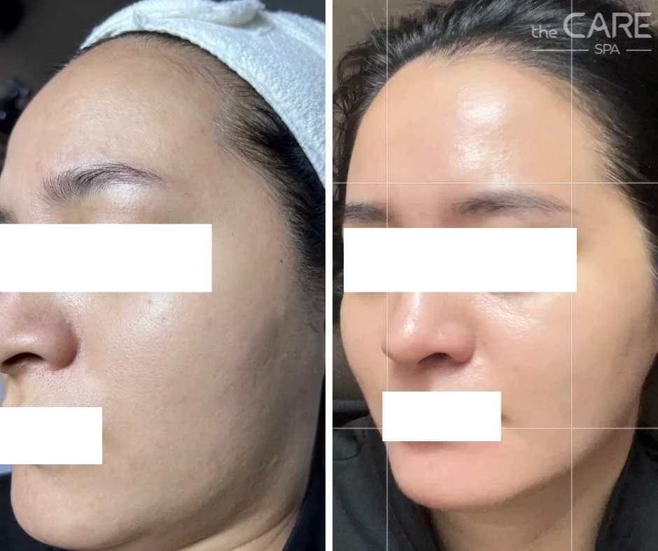 Kết quả trước và sau điều trị da tại The Care Spa