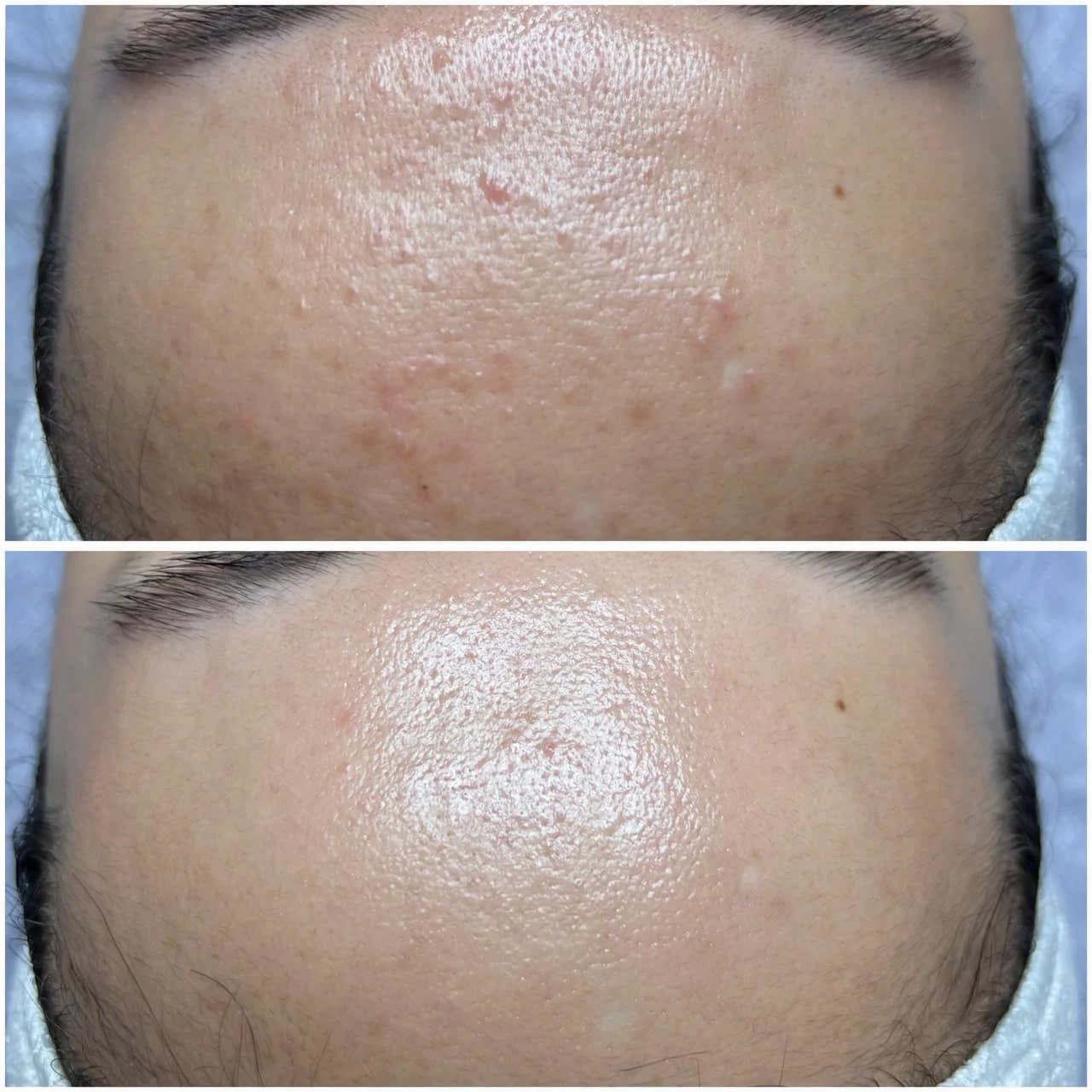 Kết quả trước và sau điều trị da tại The Care Spa