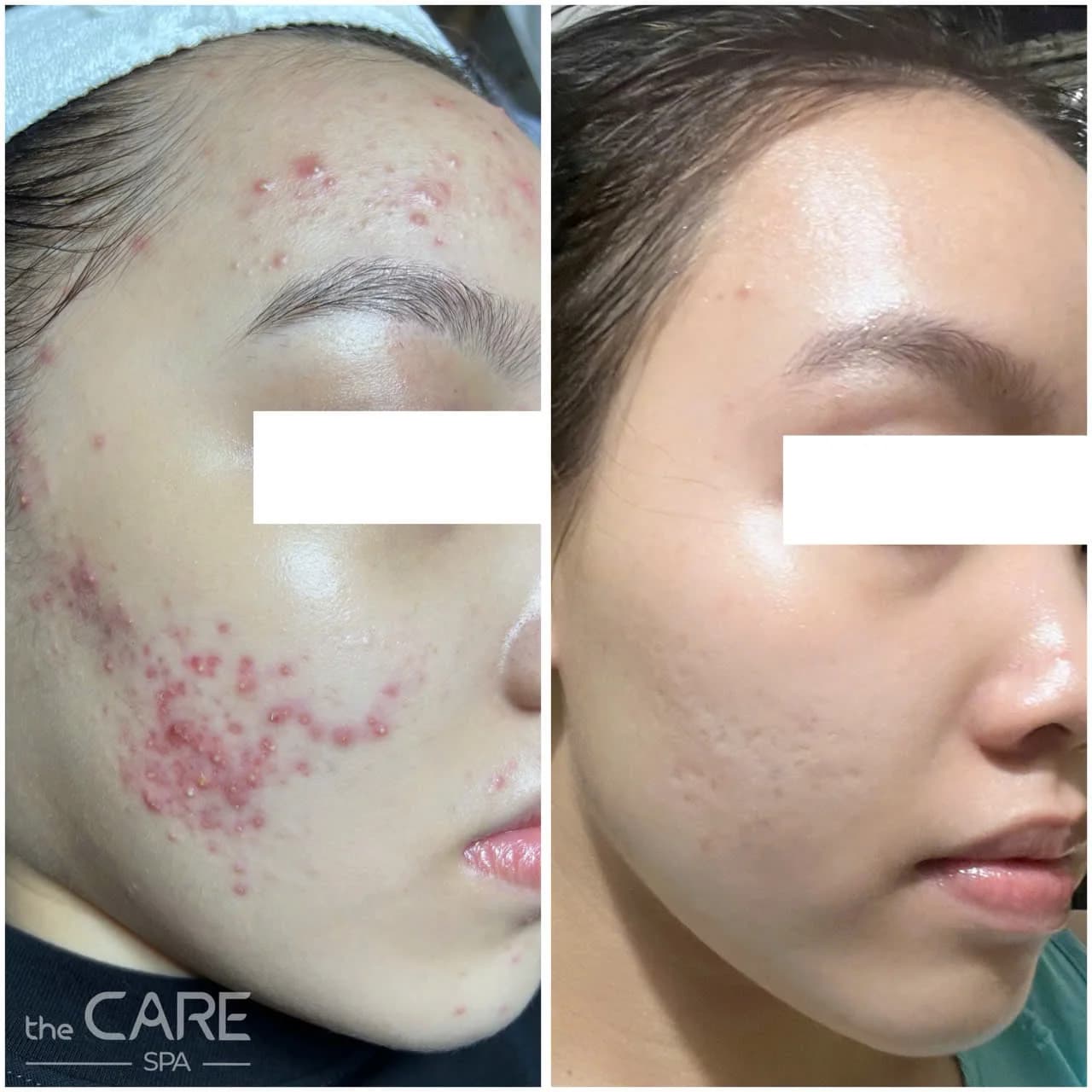 Kết quả trước và sau điều trị da tại The Care Spa