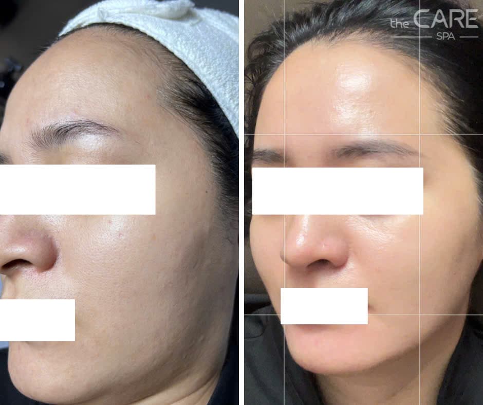 Kết quả trước và sau điều trị da tại The Care Spa